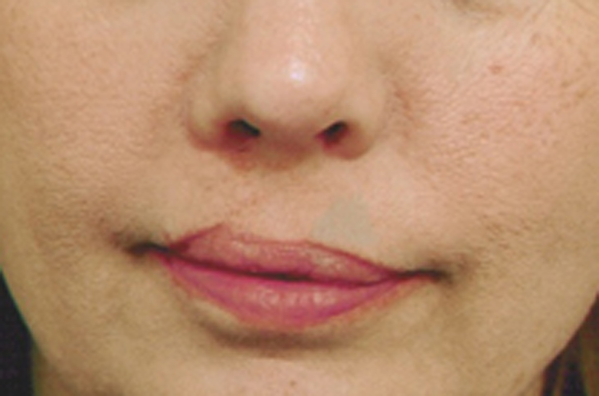 Blog-September-20-CleftPatient2After.jpg